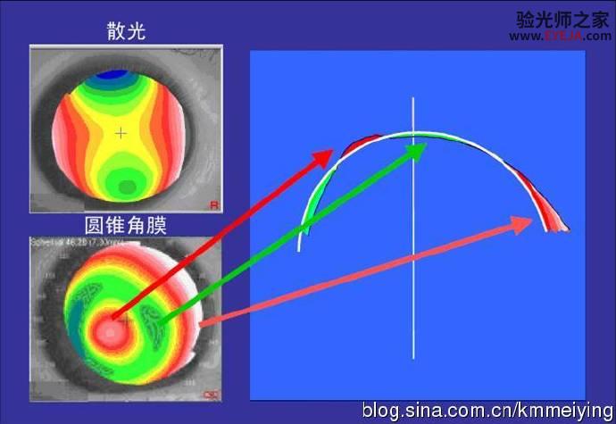 再说说几种常用的角膜地形图类型 再说说几种常用的角膜地形图类型