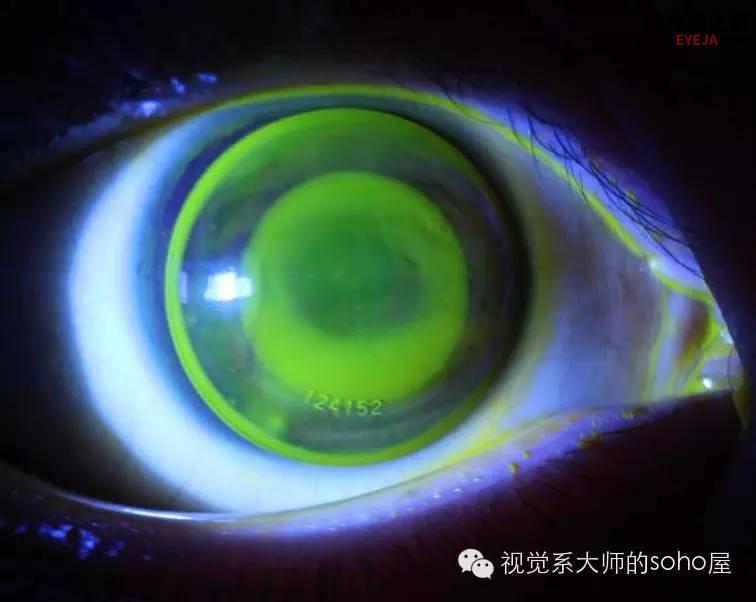 转载:如何选择角膜塑形镜的品牌 转载:如何选择角膜塑形镜的品牌