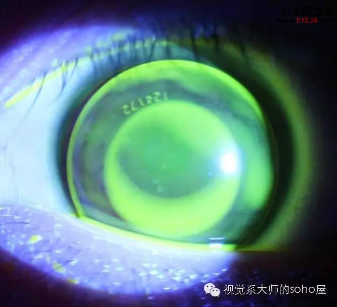 转载:如何选择角膜塑形镜的品牌 转载:如何选择角膜塑形镜的品牌