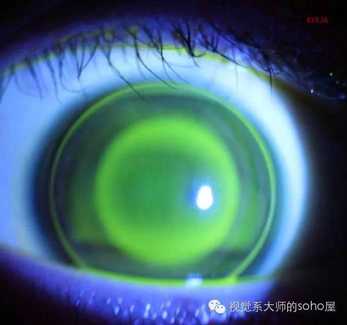 转载:如何选择角膜塑形镜的品牌 转载:如何选择角膜塑形镜的品牌