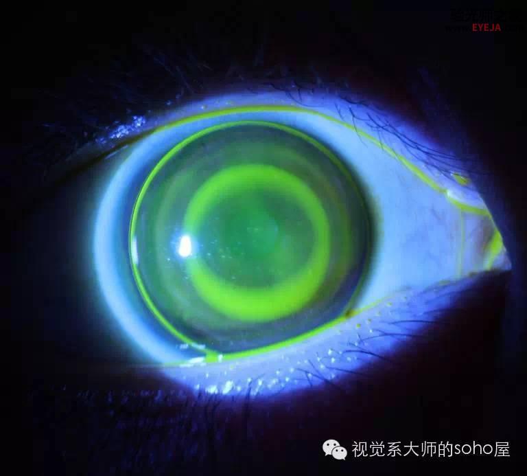 转载:如何选择角膜塑形镜的品牌 转载:如何选择角膜塑形镜的品牌