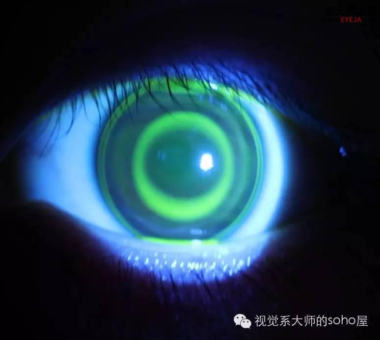 转载:如何选择角膜塑形镜的品牌 转载:如何选择角膜塑形镜的品牌