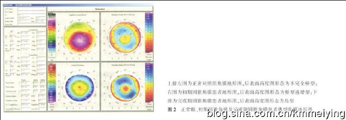 读书《圆锥角膜患者角膜地形图形态学特征》 读书《圆锥角膜患者角膜地形图形态学特征》