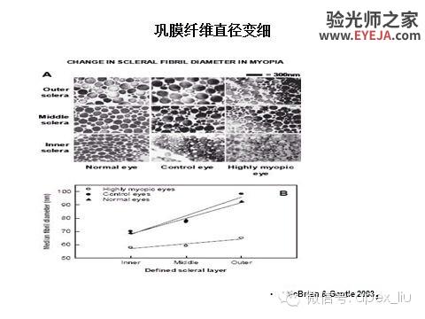 推荐阅读(转载):尖峰眼科课程分享之近视眼发病机理研究 推荐阅读(转载):尖峰眼科课程分享之近视眼发病机理研究
