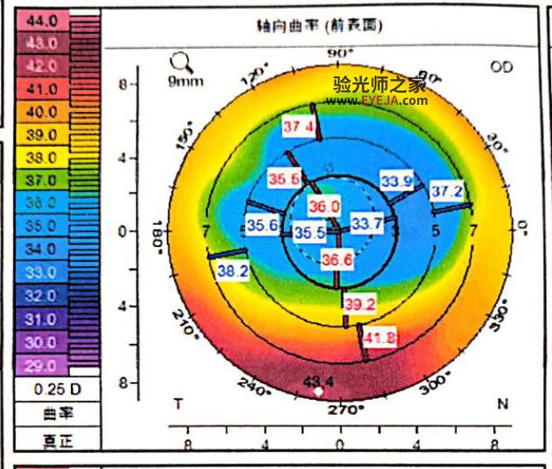 屈光手术后高阶像差的症状
