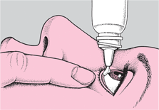 泪小管炎-眼疾-插图-2 泪小管炎-眼疾-插图-2