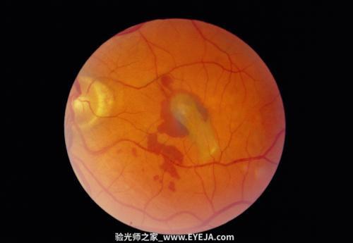 视网膜脱离-眼疾