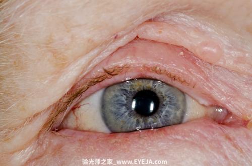 睑缘炎-眼疾-插图-1 睑缘炎-眼疾