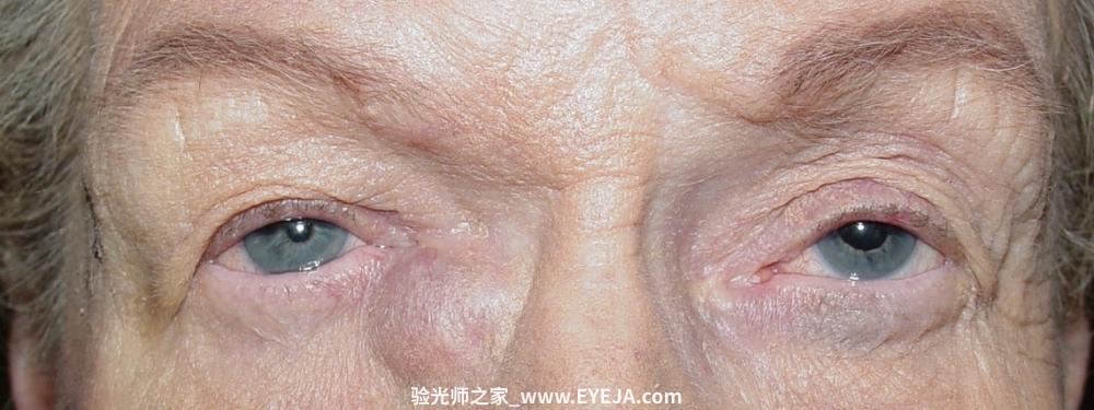 泪囊炎-眼疾 – 验光师之家