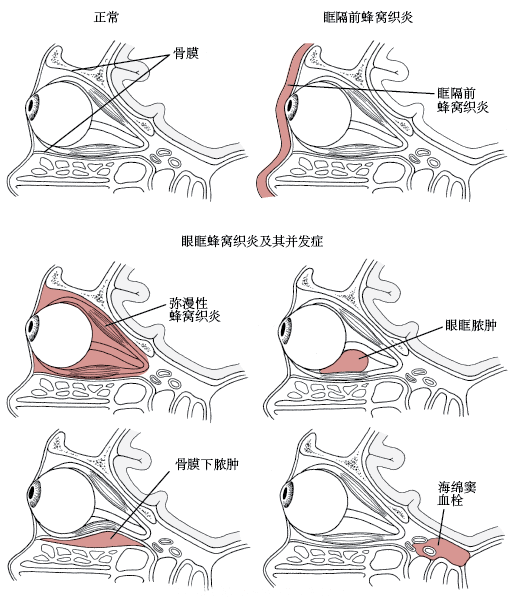 眶隔前和眼眶蜂窝织炎-眼疾 – 验光师之家