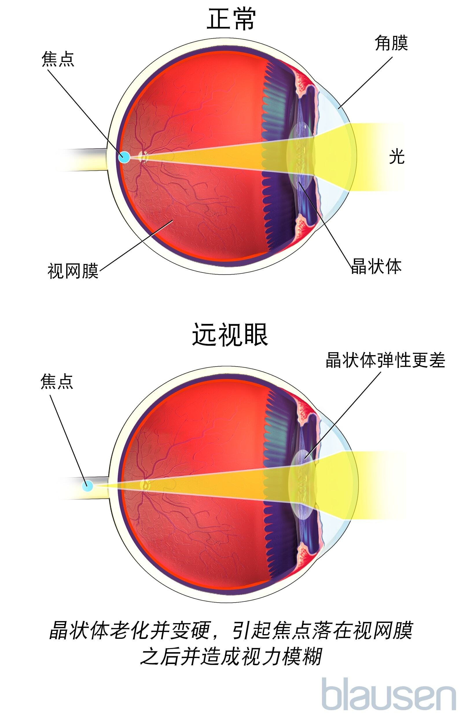 屈光不正的概述 – 验光师之家