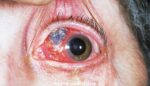 巩膜炎-眼疾-插图-1