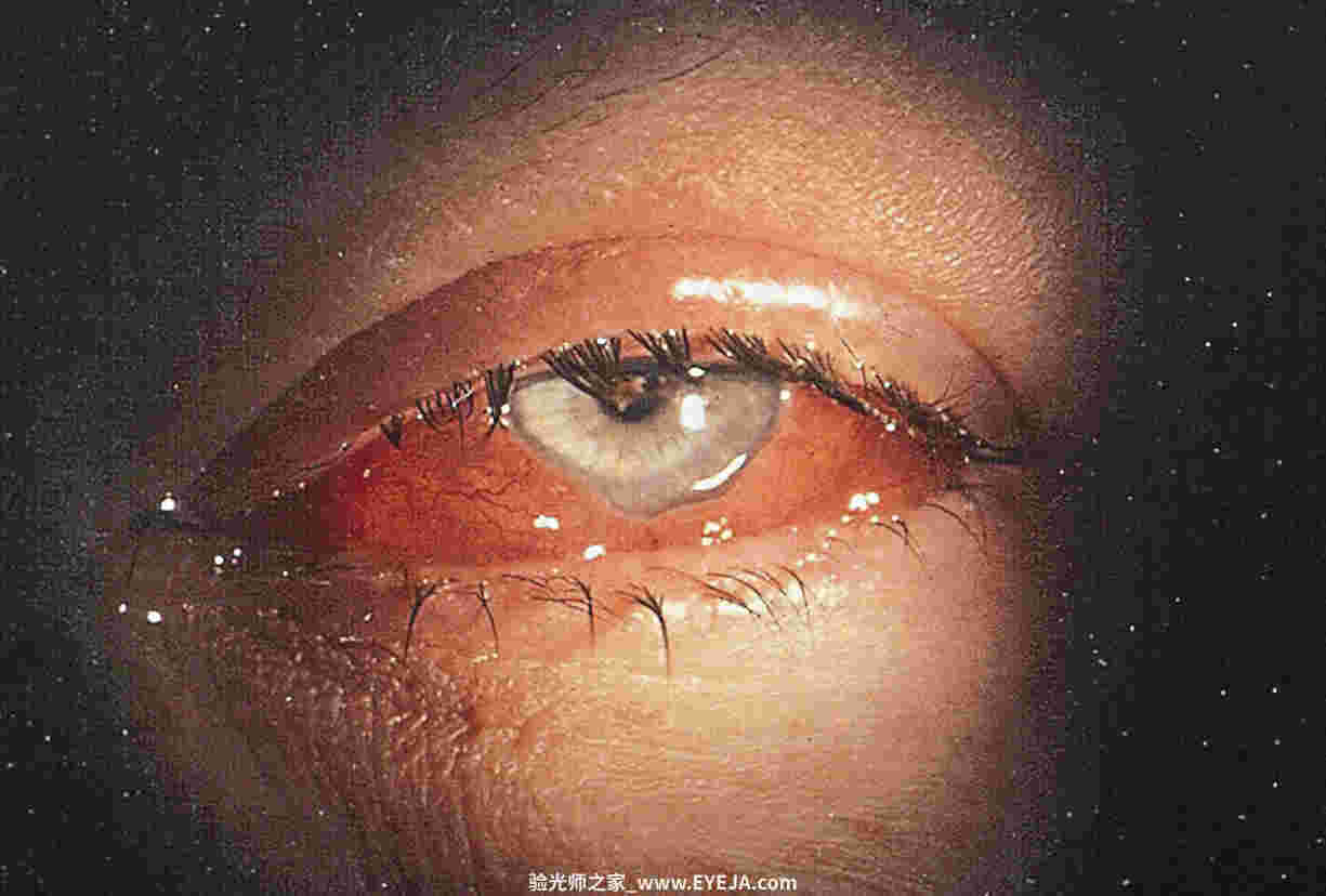 结膜和巩膜疾病的概述-眼疾