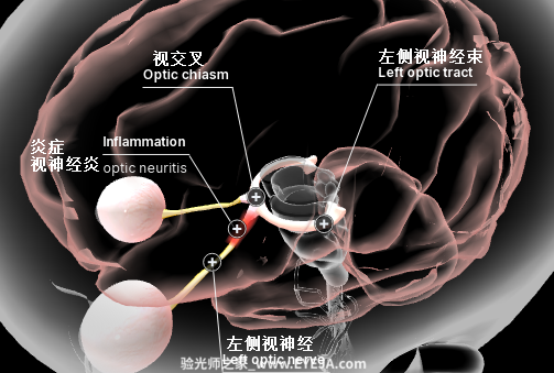 视神经炎-眼疾