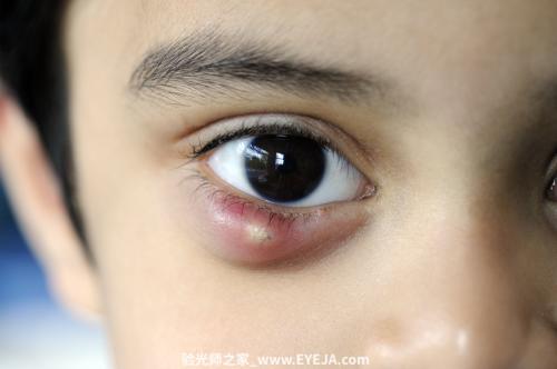 睑板腺囊肿和睑腺炎（麦粒肿 针眼）-眼疾