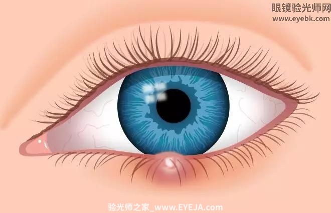 1分钟教会你认识麦粒肿，眼内结石、滤泡、