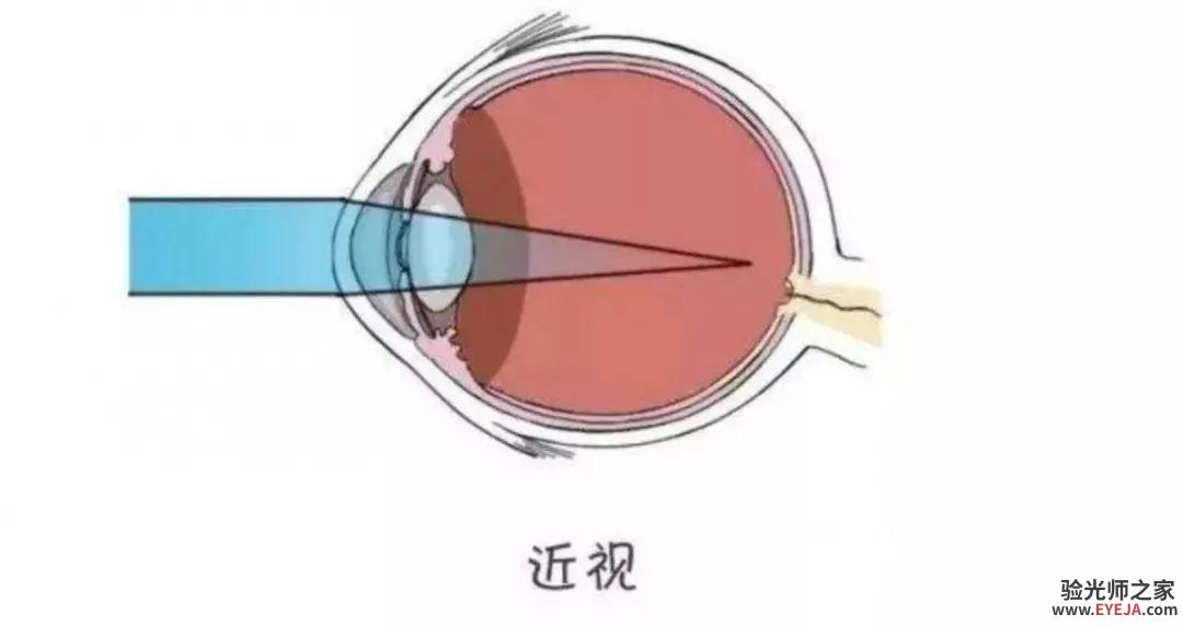 孩子的近视度数会随着身体发育、身高的增长而增长！