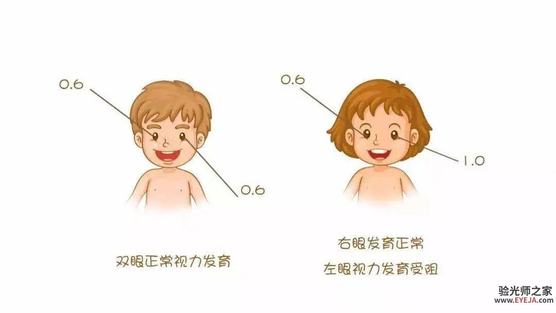 孩子弱视不能拖，千万别错过治疗黄金期！