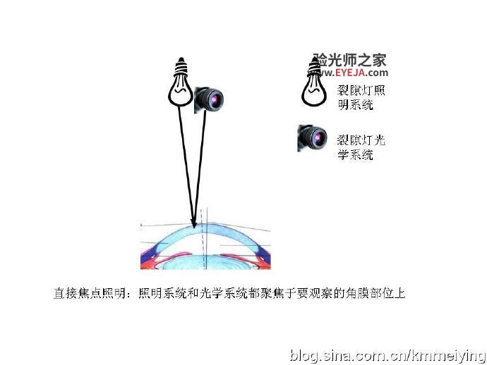 裂隙灯后部照明法