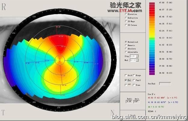 几个与单纯散光类似的圆锥角膜案例
