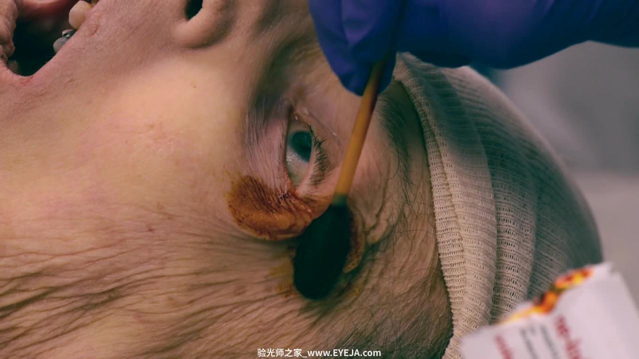 眼睛外眦切开术如何进行的（外眼角切开术）