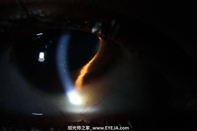 葡萄膜炎的概述