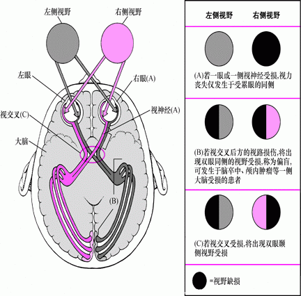 急性视力下降-眼疾症状